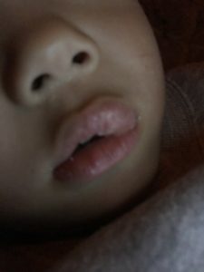 子供が歯医者の麻酔で唇が腫れた時の画像